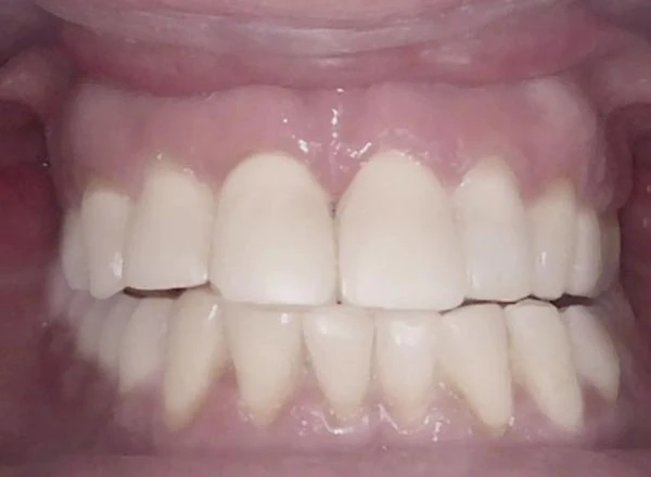 After image